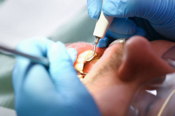 Best Broken or Cracked Tooth Emergency Dentist in Elmore, AL